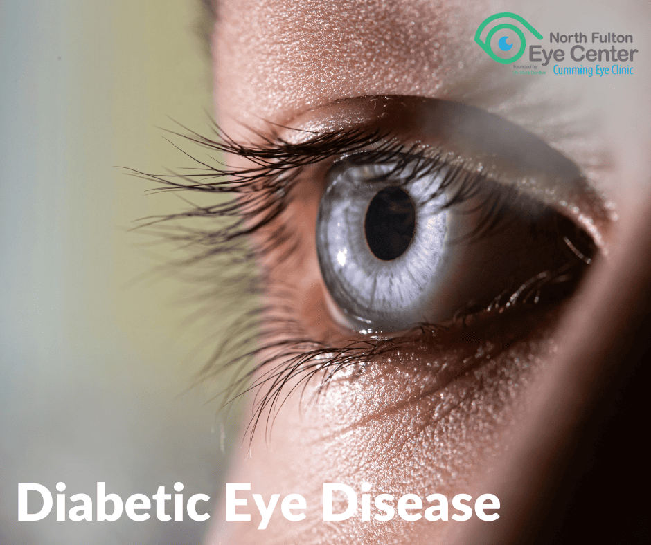 Diabetic Eye Disease: Why Routine Eye Exams Matter at Every Age in North Fulton